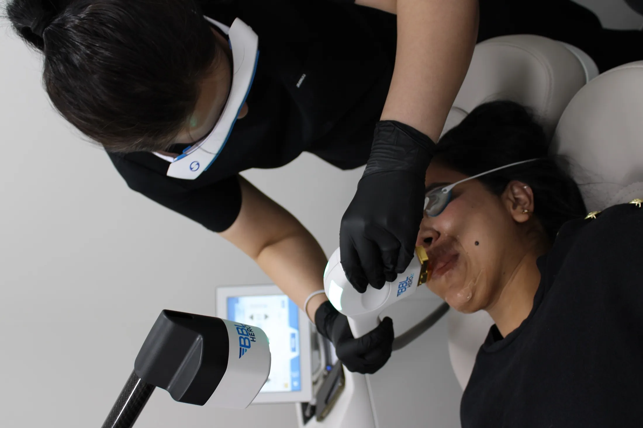 A clinician treats a patient’s upper lip with the BBL handpiece