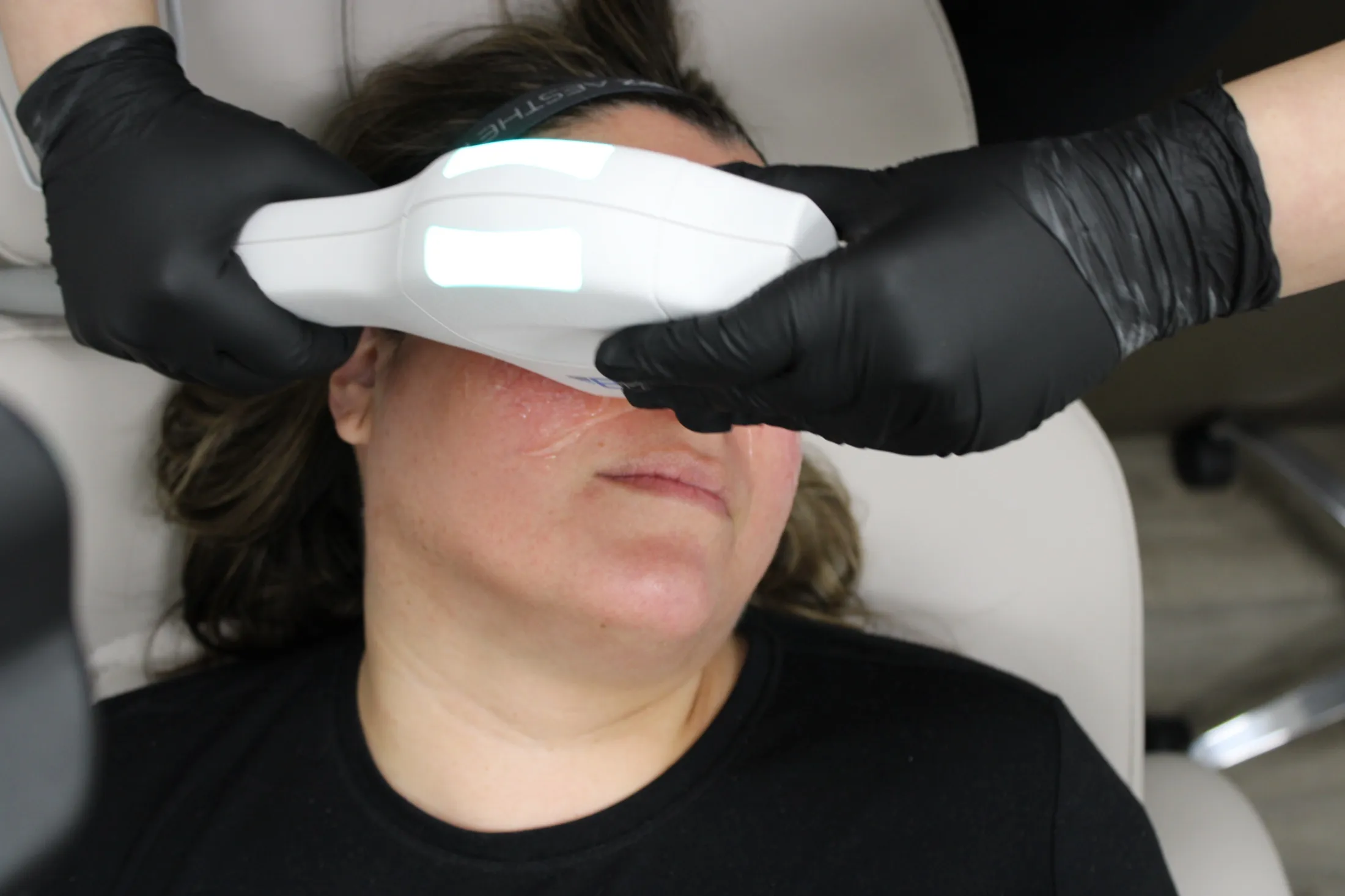 A patient with facial redness receives a BBL light treatment with protective eye coverage