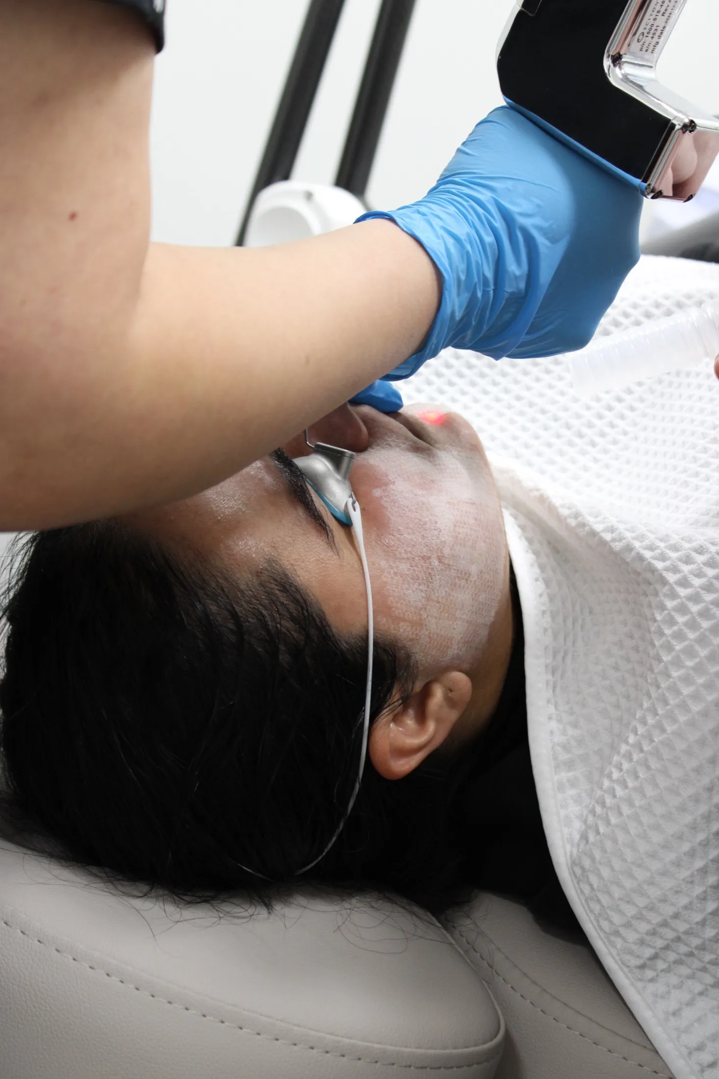 A laser peel in progress on a patient’s cheek, the aiming beam visible on the skin