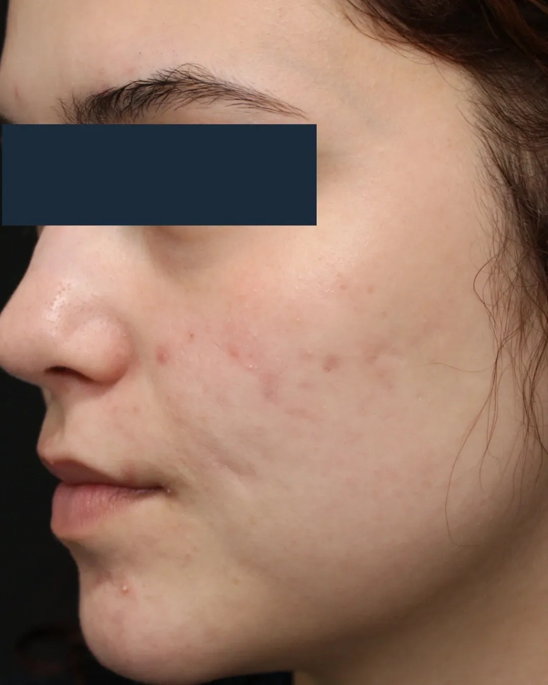 After Forever Clear BBL® treatment