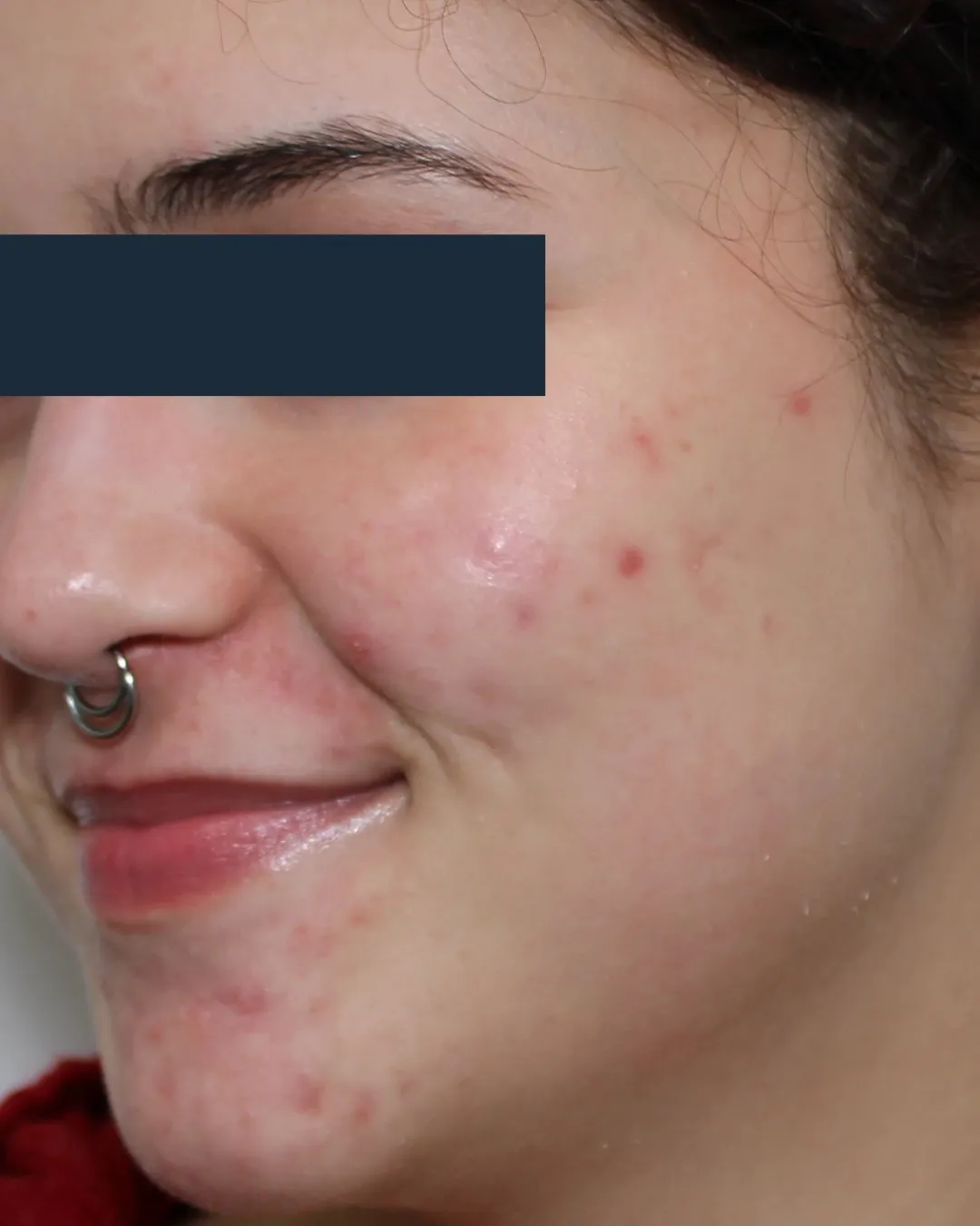 Before Forever Clear BBL® treatment