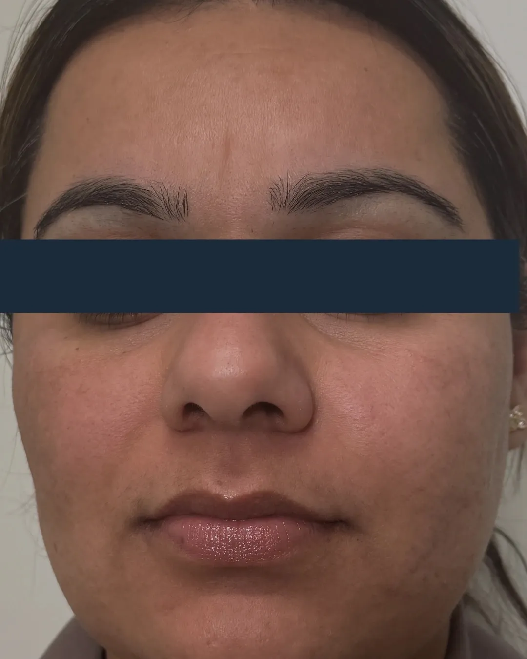 After HALO® treatment