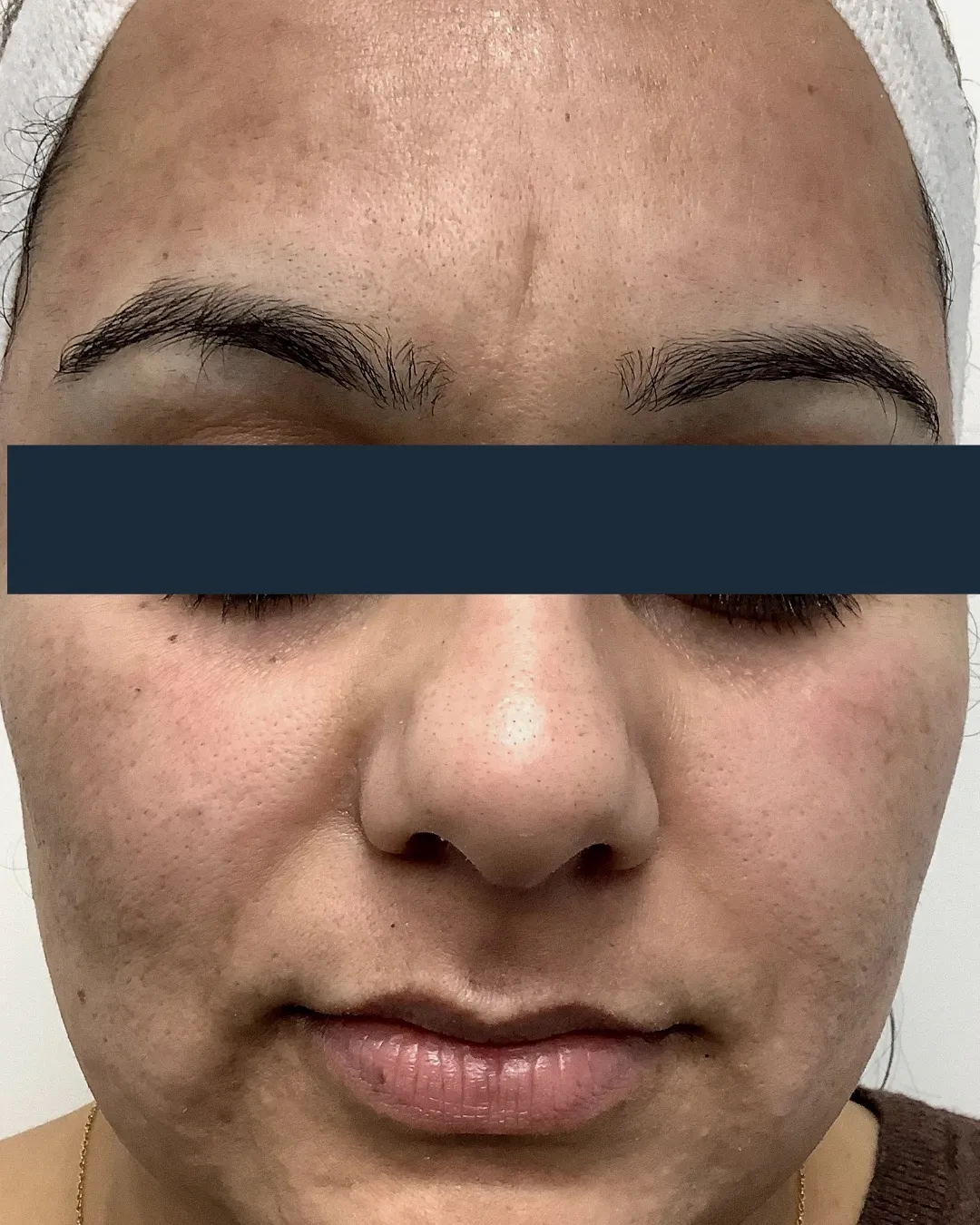 Before HALO® treatment