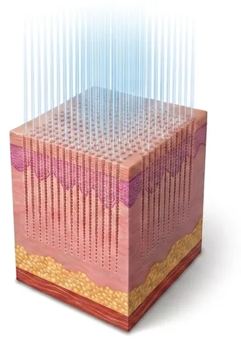Fractional laser delivering many pinpoint beams into microscopic columns with untouched skin between them