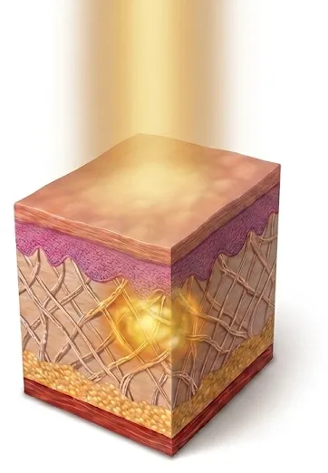 Non-ablative laser warming the collagen fibres of the dermis while the skin surface stays intact