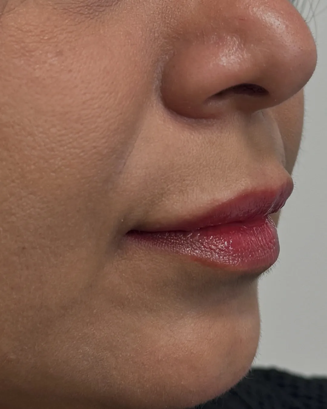 After Lip Filler treatment