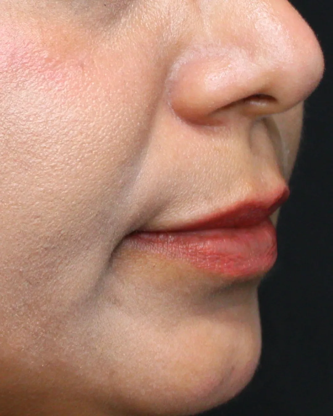 Before Lip Filler treatment