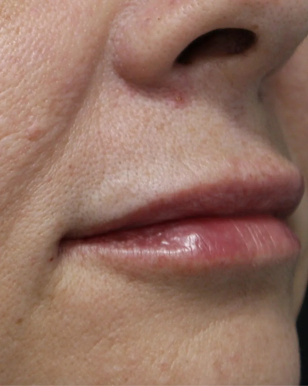 After Lip Filler treatment