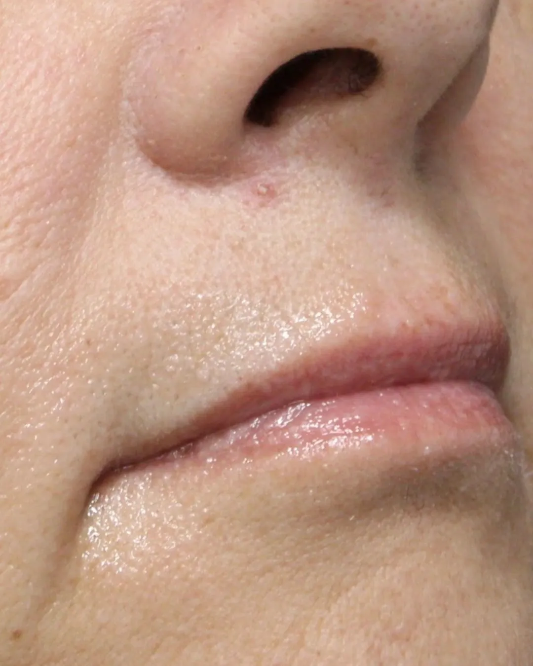 Before Lip Filler treatment