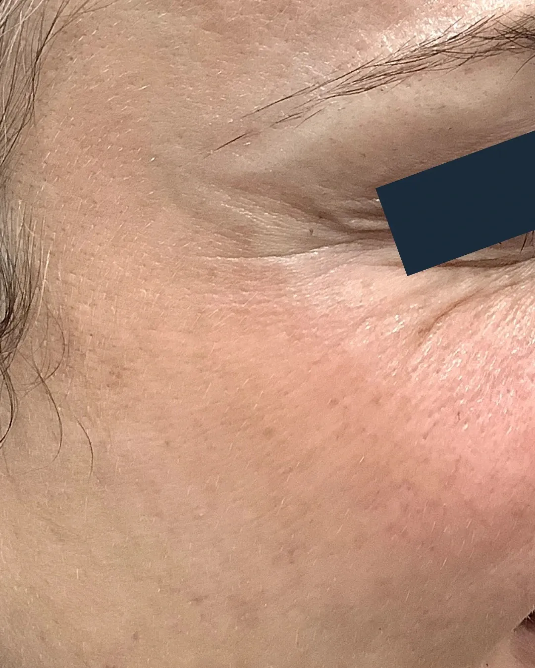After Neuromodulator treatment