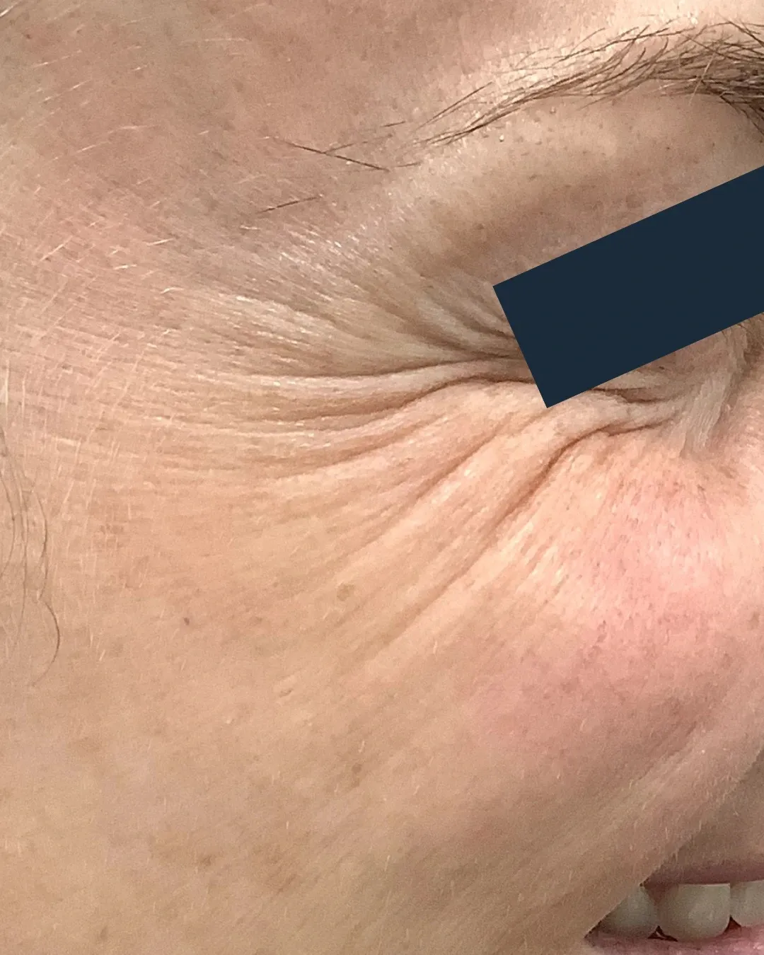 Before Neuromodulator treatment