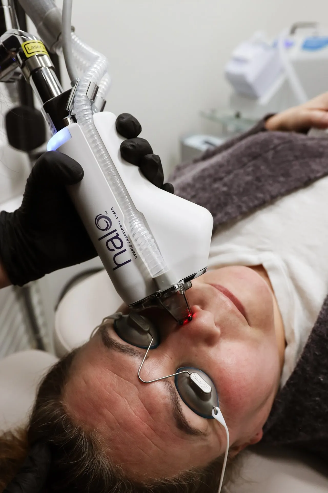 The Halo hybrid fractional laser handpiece with its red aiming beam on a patient’s cheek