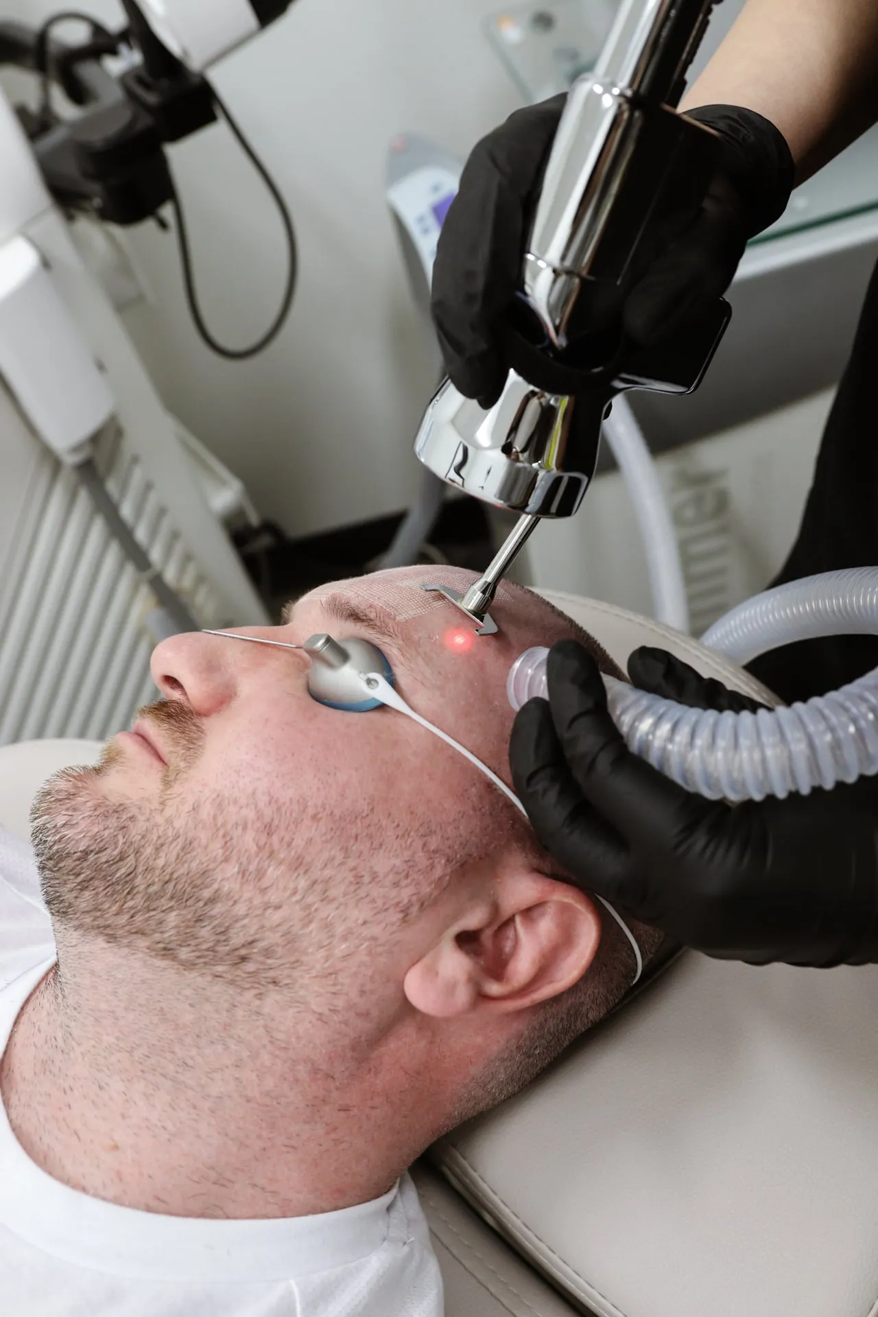 A fractional laser treatment in progress on a male patient