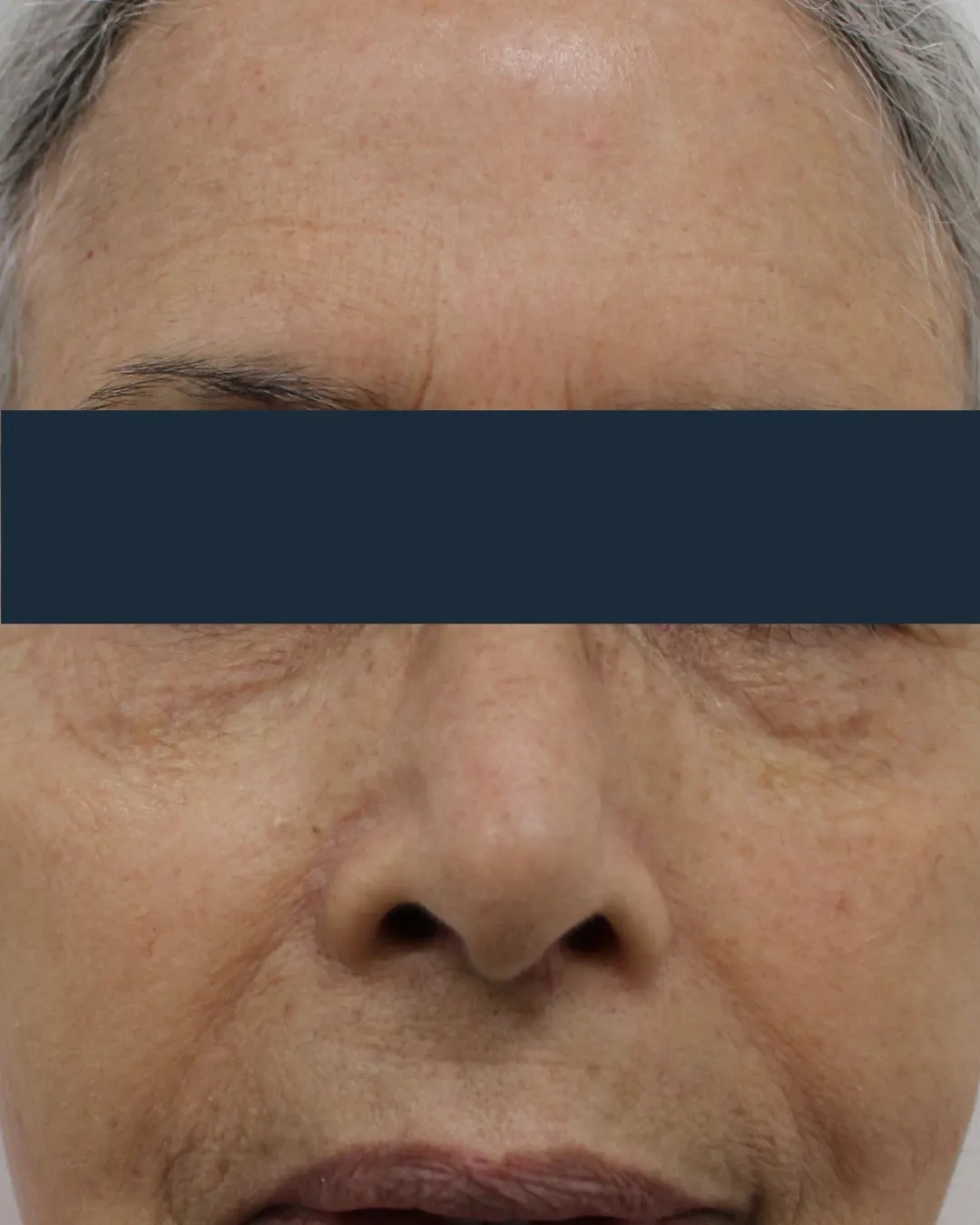 After SkinTyte® treatment
