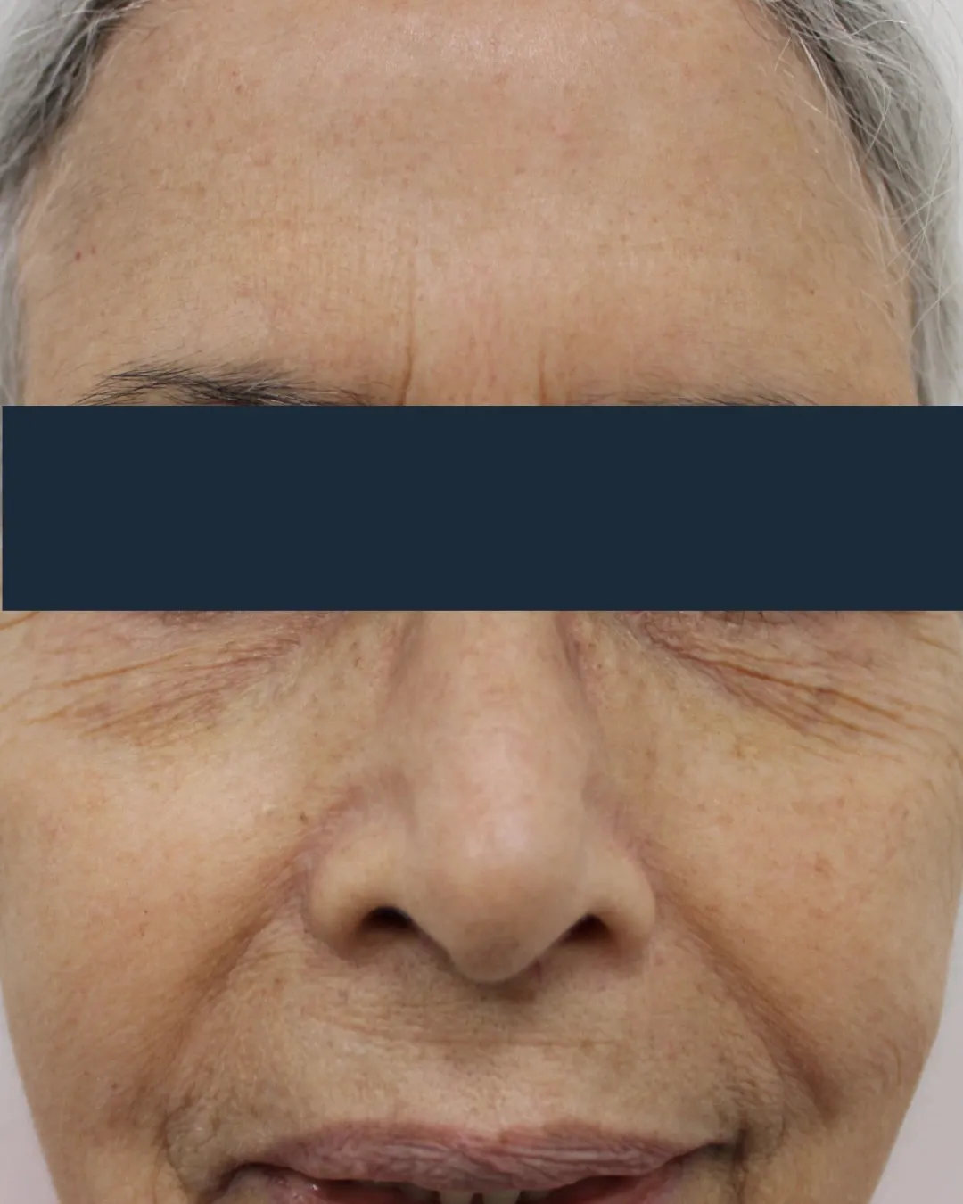 Before SkinTyte® treatment
