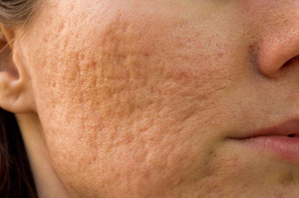 Acne Scarring Treatment