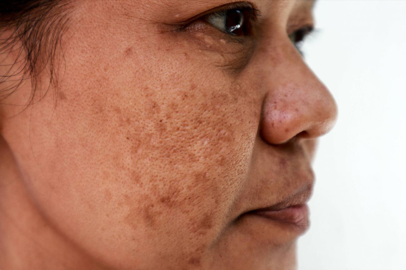Melasma Treatment