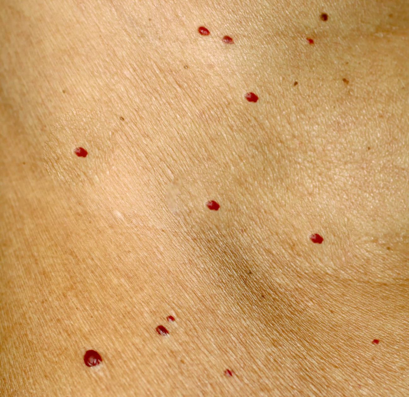 Cherry Angiomas Treatment