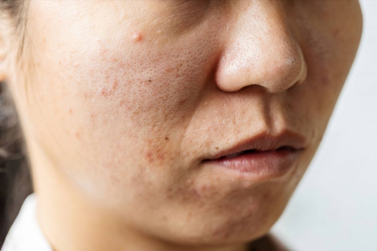 Dull or Uneven Skin Tone Treatment