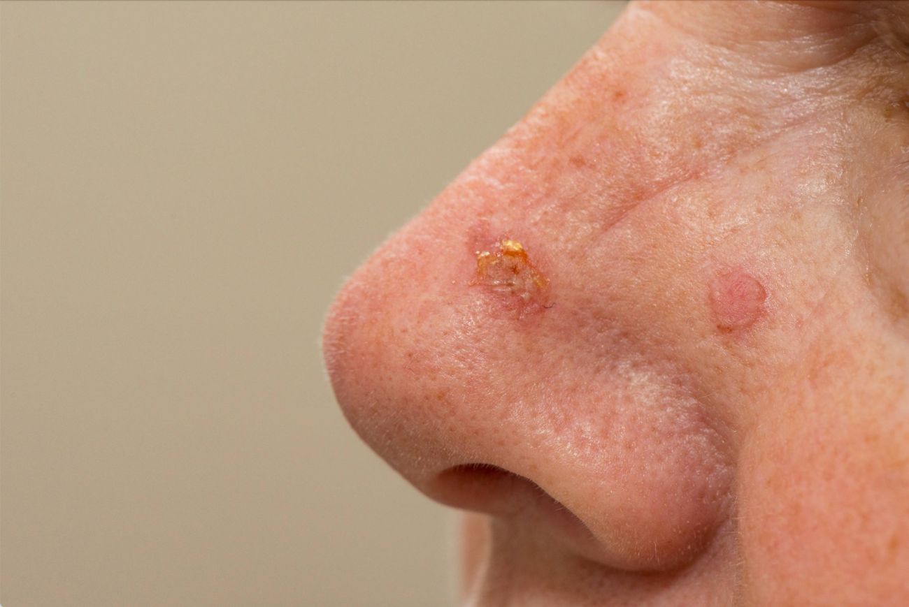 Actinic Keratosis Treatment