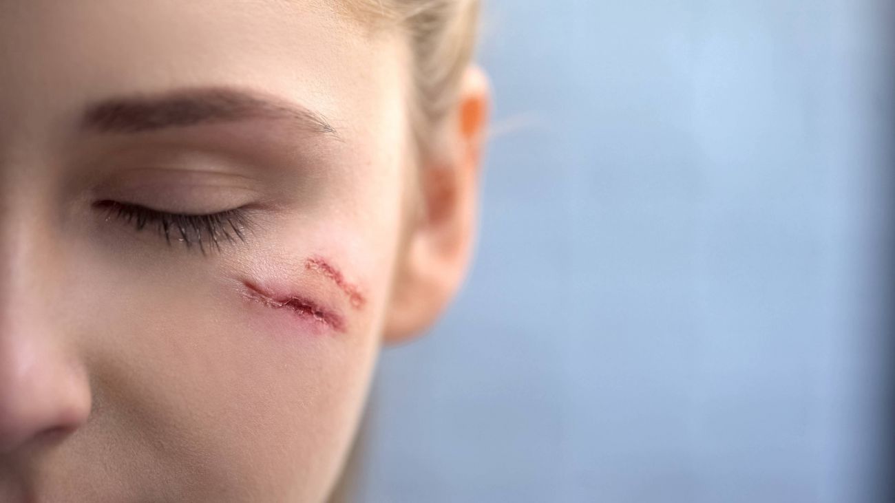 Scar Treatment