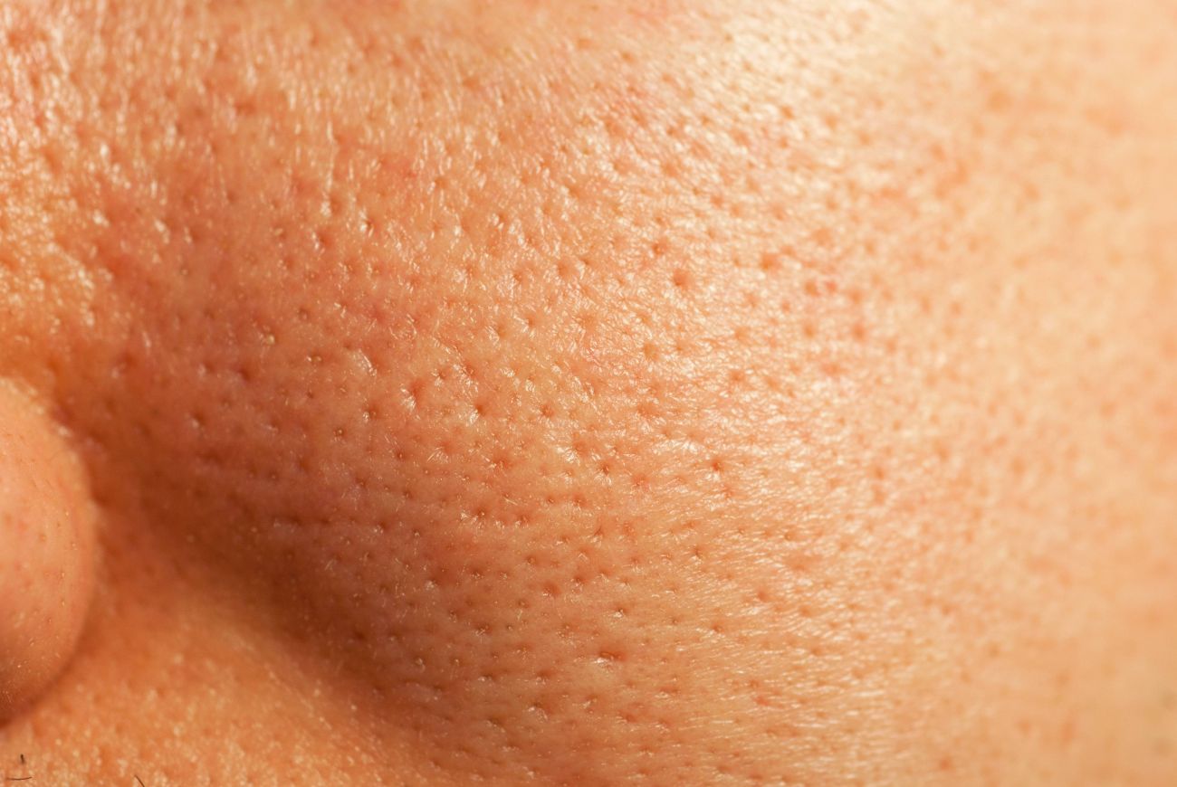 Enlarged Pores Treatment