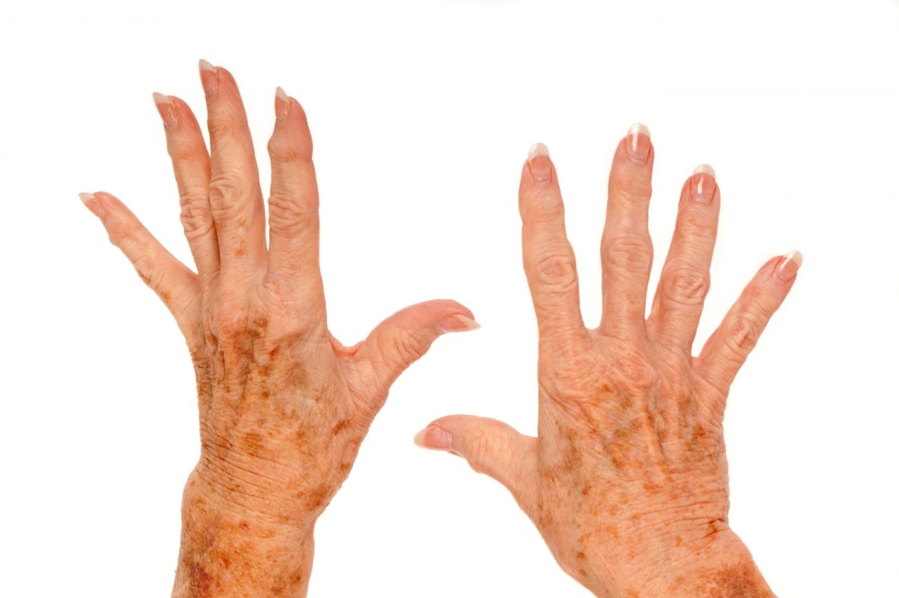 Age Spots / Sun Spots Treatment