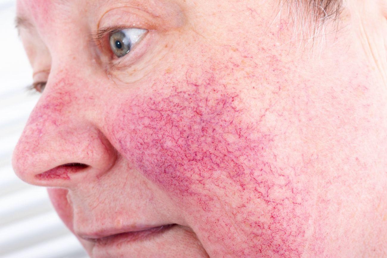 Rosacea Treatment