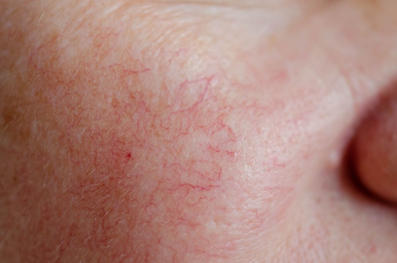 Telangiectasias Treatment